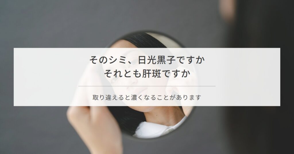 シミの種類は日光黒子か肝斑かで対処が変わることを解説する記事のアイキャッチ